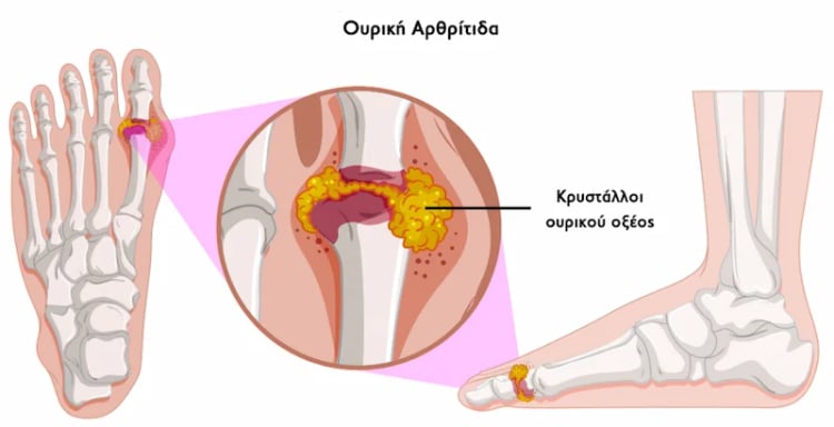 Ουρική Αθρίτιδα infographic